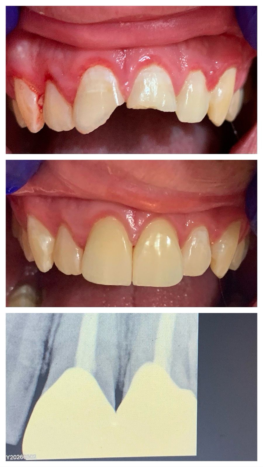 Before and after of a single front tooth implant and crown