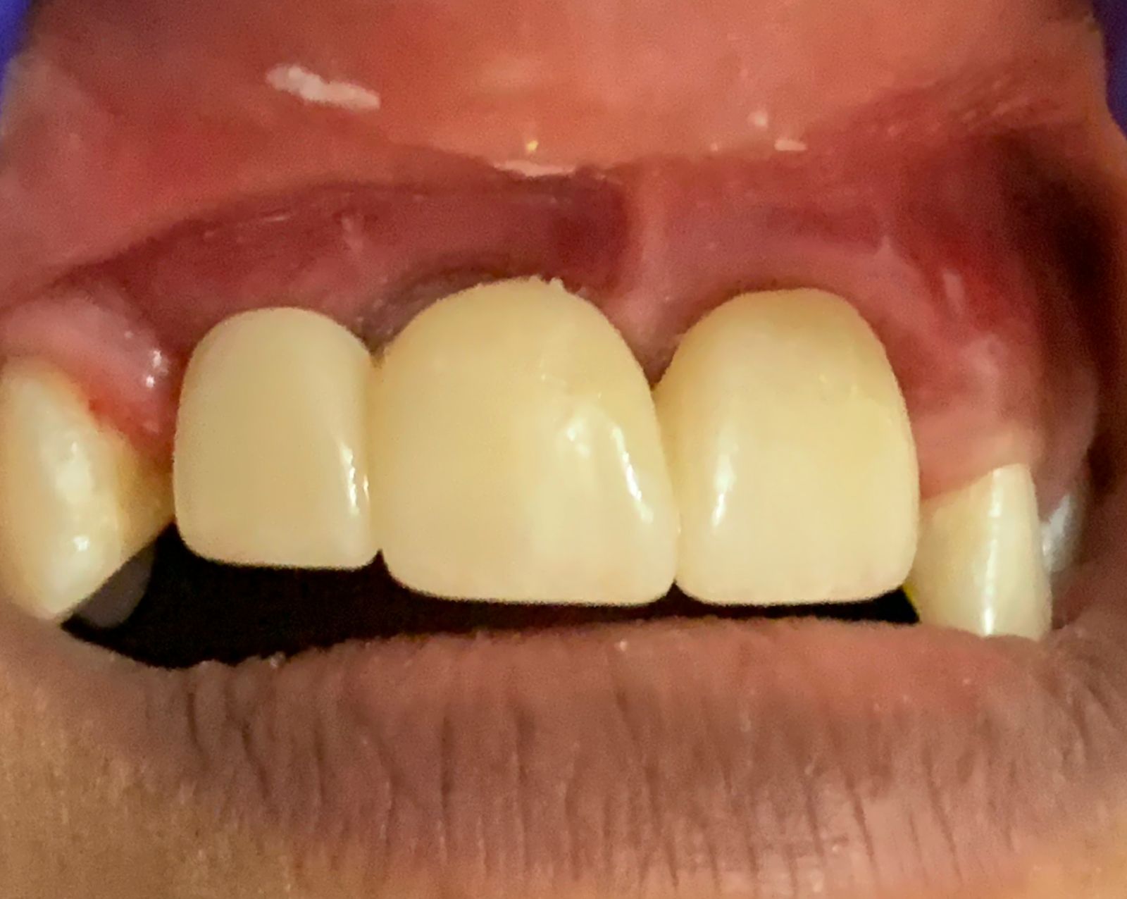 Two front dental crowns after treatment