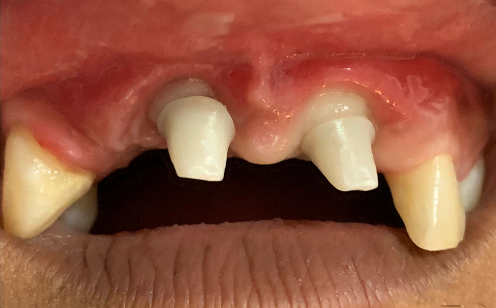 Before: two dental implant abutments, missing front teeth
