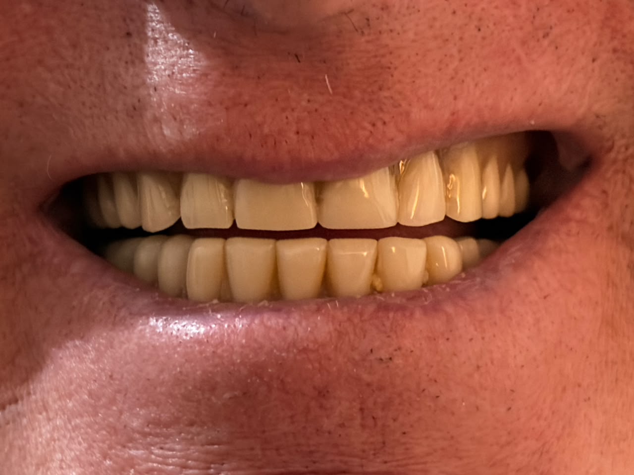 Close-up of upper and lower arches after treatment