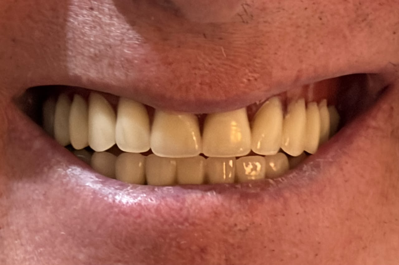 Close-up of full smile after treatment